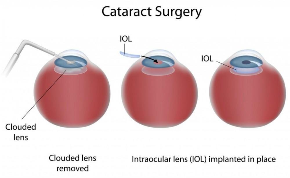 cataract