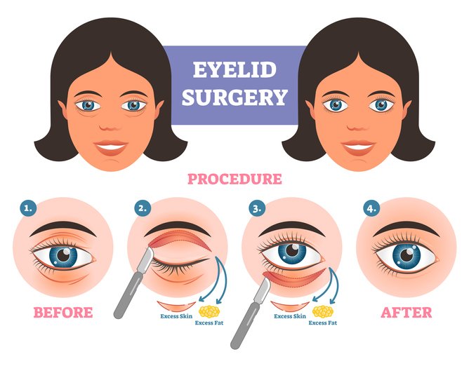eyelidsurgery