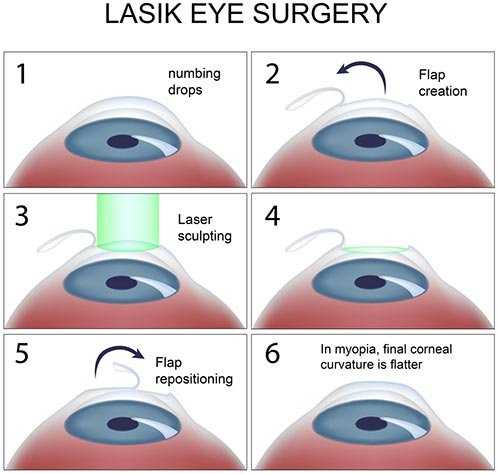 lasik